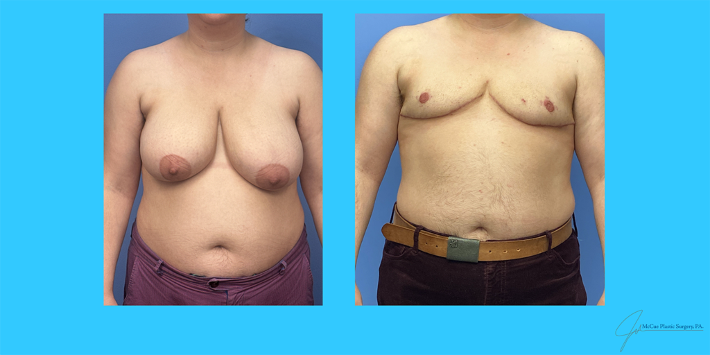 Before and After Image: Top Surgery - front