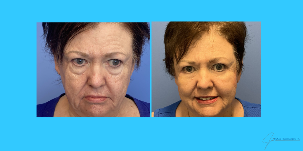 Before and After Image: blepharoplasty - front